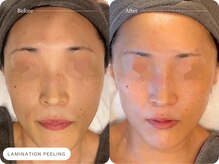 キュレイテッドスキン(CURATED SKIN)/ニキビ/シミ/毛穴/肌質改善/神戸