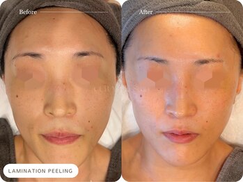 キュレイテッドスキン(CURATED SKIN)/ニキビ/シミ/毛穴/肌質改善/神戸