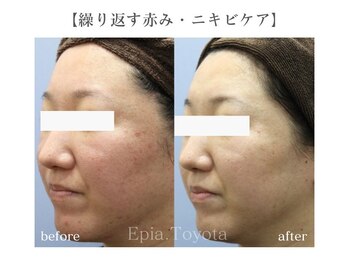 エピア 豊田店(Epia)/ニキビケア・敏感肌ケア
