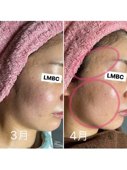 ルーチェエムベルシック(Luce.MBelChic)/スノーピール★