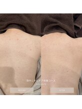 タグ 高知駅前店(Tug)/背中ニキビケア