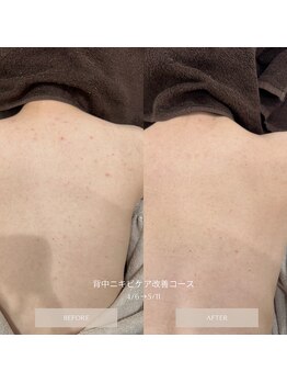 タグ 高知駅前店(Tug)/背中ニキビケア