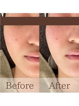 凪眠/小顔リンパフェイシャルの効果16