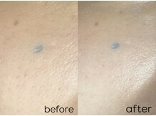 リノア 堀江(Linoa)/毛穴　透明感