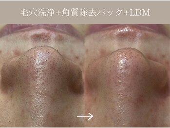 リィ プラス(Riii plus)/【毛穴ケア敏感肌の方でも◎】