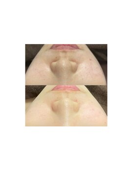 チェルト 鈴鹿店(CERTO)/REVIハーブピーリング