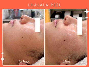 ハノハノ 八代店(HANO HANO)/韓国肌管理ララピール☆