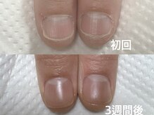 アメジスト(Amethyst)/深爪矯正の2回目！大成長中！