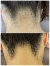 ルーメ(lume)/うなじ脱毛/20代女性