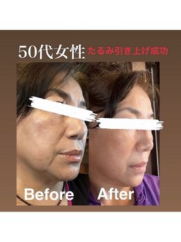 ギンザ リボーン(Ginza Reborn)/たるみ引き上げ