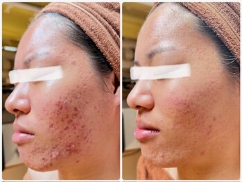 ムー ブランチ(Mou Branch)/プラズマシャワー