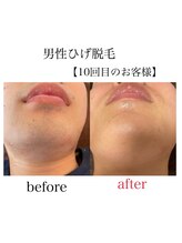 ボータン 恵(Beau Temps)/男性ひげ脱毛10回されたお客様