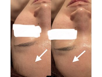 バリスパアラミー(balispa Alami)/before→after