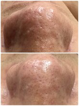 プリューム(Plume)/イチゴ鼻、ニキビケアにも