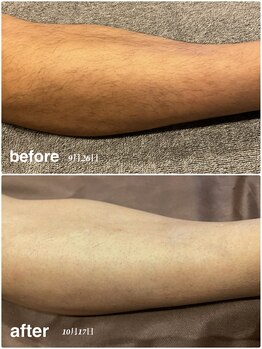 ソルエユニーク(Le seul et unique)/美肌効果もある脱毛★