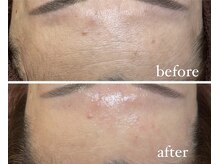 レシェルサロン(Lechelle Salon)/ハーブピーリング