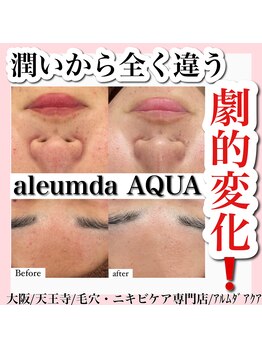 アルムダアクア 天王寺店(Aleumda AQUA)/ハーブピーリング/大阪/天王寺