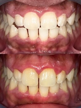 アルクローゼット(aru closet)/ホワイトニングビフォーアフター