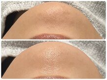 エフェクト 塚口店(effect)/Before After &nbsp;&nbsp;30代/1回目