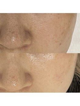 アリム(alim)/セラピールビフォーアフター