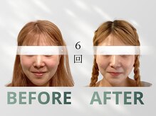 ハリット(haritt)/美容鍼B/A