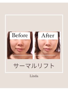 リンダ 西宮店(LINDA)/サーマルリフト