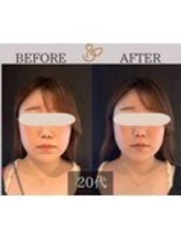 チョコバリ 錦糸町店(chocobari)/小顔×リフトアップ(美容鍼)20代