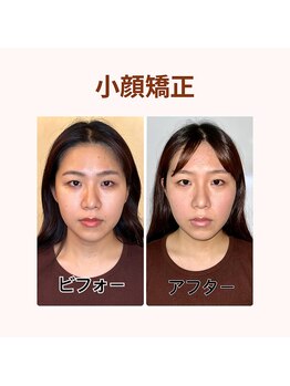 プレシャス(PRECIOUS)/小顔矯正