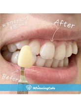 ホワイトニングカフェ 郡山店/＊ホワイトニング症例写真＊