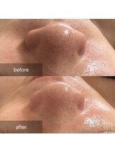 ナウ(now)/『陶肌トリートメント』