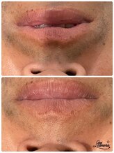 ビモア(Bmore)/★LED脱毛4回の効果★