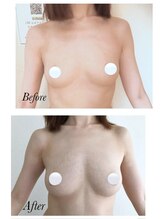 美人バスト 豊橋店/バストアップ症例「バストケア」