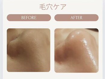 美々庵/ハイドラ 毛穴洗浄