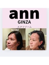 アン 銀座(ann)/エクソソーム