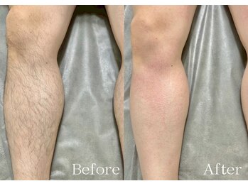 シルビー(CILBE)/脚MIX脱毛