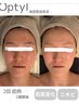 韓国発!高密度超音波Optyl☆再生+リフティング!!ヒアルロン酸導入付¥13000