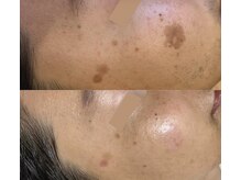 リセット(Re:set)の雰囲気（【光フェイシャル】ダウンタイムなし！痛みなし◎当日メイクOK◎）