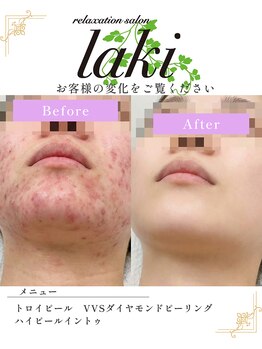 リラクゼーションサロン ラキ(laki)の写真/敏感肌も解決*艶肌もトラブル肌改善も!全て1:1で肌管理できる最新トロイアルケ!サロンレベル超えの超艶肌へ
