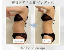アピ(api)/症例写真【産後インディバ】