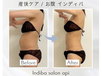 アピ(api)/症例写真【産後インディバ】