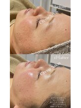 クレヴィー(Creviy)/韓国式3D毛穴洗浄×ハーブ