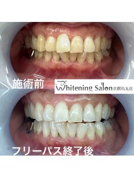 ホワイトニングサロン 京都烏丸店/ホワイトニング施術例
