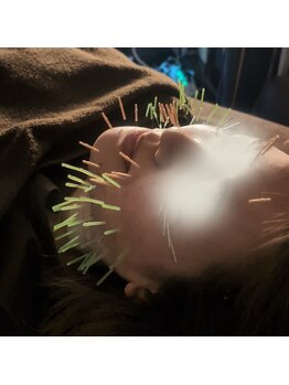 あいこ鍼灸院/天使の100本美容鍼