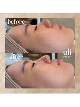 ウリ(uli beauty)/比較写真