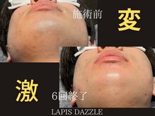 ラピスダズル(LAPIS DAZZLE)/ひげ脱毛☆途中経過