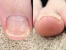 巻き爪ケア【完了】
