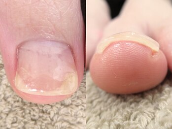 巻き爪ケア【完了】