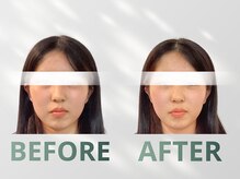 ハリット(haritt)/美容鍼B/A