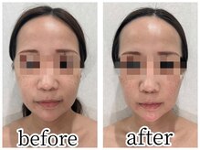 イデアルボーテ/ハイパーナイフで小顔に！