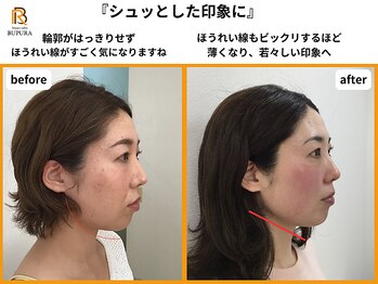 ブプラ 香椎店(BUPURA)/before→after